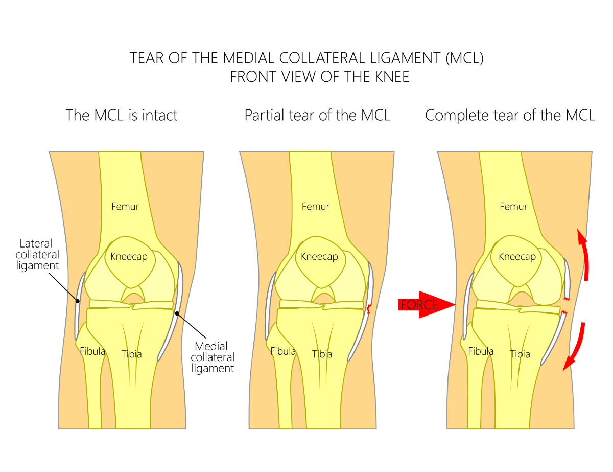 MCL-Tear